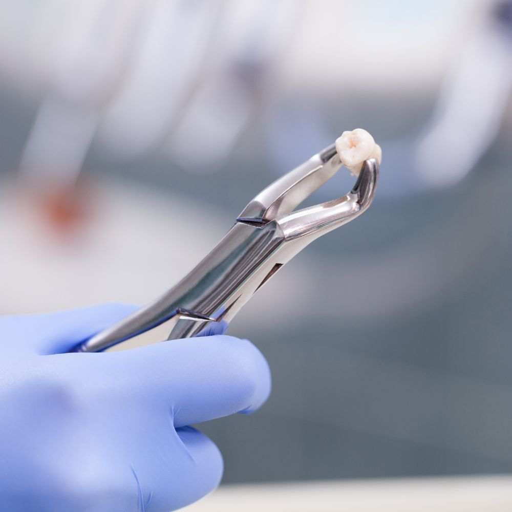 Extracciones Dentales en Tijuana